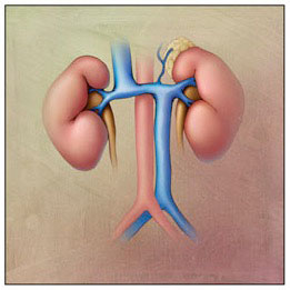 Anatomic variant:Left sided IVC